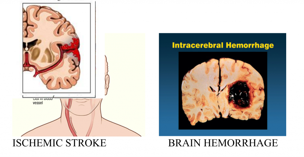 Blog of Stroke and Neuro Clinic – Stroke and Neuro Clinic was ...